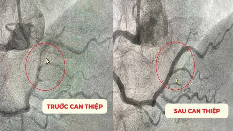 Cần Thơ: Can thiệp thành công ca tái hẹp nặng trong stent mạch vành đã đặt ở nước ngoài Cần Thơ: Can thiệp thành công ca tái hẹp nặng trong stent mạch vành đã đặt ở nước ngoài