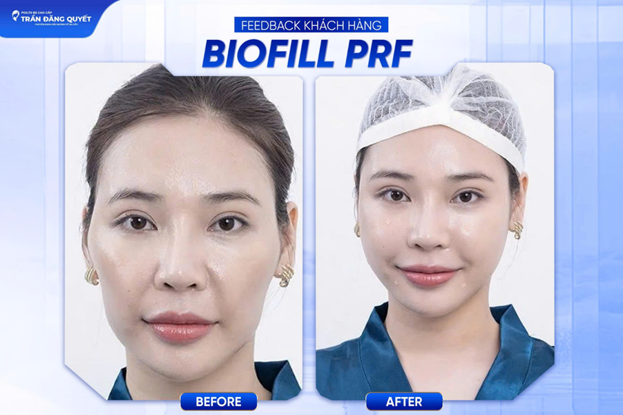 Kết quả sau khi cân chỉnh gương mặt bằng phương pháp BIOFILL PRF Kết quả sau khi cân chỉnh gương mặt bằng phương pháp BIOFILL PRF