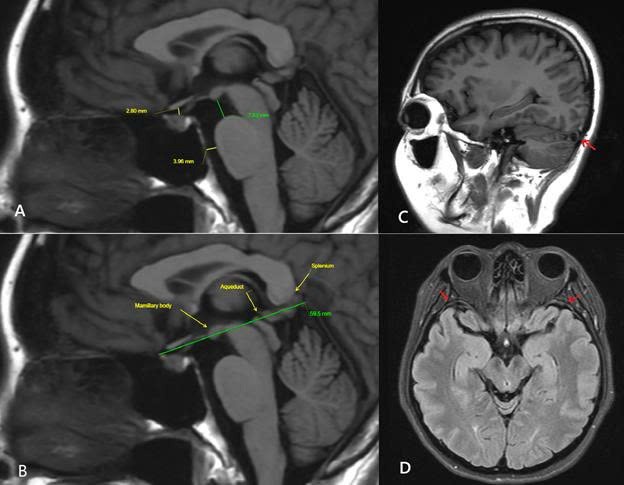MRI sọ não lần 3 ghi nhận nhiều dấu hiệu gợi ý hội chứng giảm áp lực nội sọ do rò dịch não tủy, bao gồm: não sa thấp nhẹ, các khoang dịch quanh não thu hẹp, giãn các xoang tĩnh mạch nội sọ và dày nhẹ màng não. MRI sọ não lần 3 ghi nhận nhiều dấu hiệu gợi ý hội chứng giảm áp lực nội sọ do rò dịch não tủy, bao gồm: não sa thấp nhẹ, các khoang dịch quanh não thu hẹp, giãn các xoang tĩnh mạch nội sọ và dày nhẹ màng não.