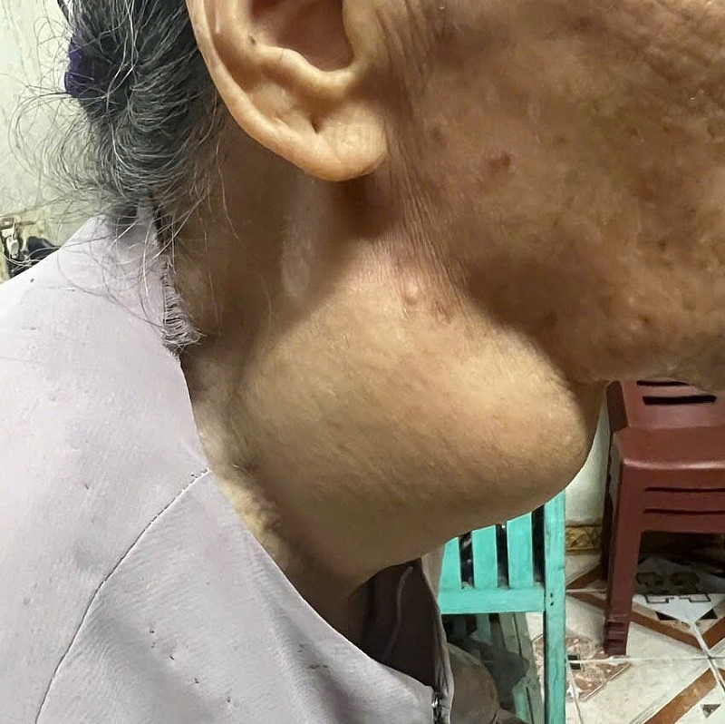 Vinmec Hạ Long giải cứu cụ bà 88 tuổi bị khối u giáp khổng lồ chèn ép đường thở suốt 18 năm Vinmec Hạ Long giải cứu cụ bà 88 tuổi bị khối u giáp khổng lồ chèn ép đường thở suốt 18 năm
