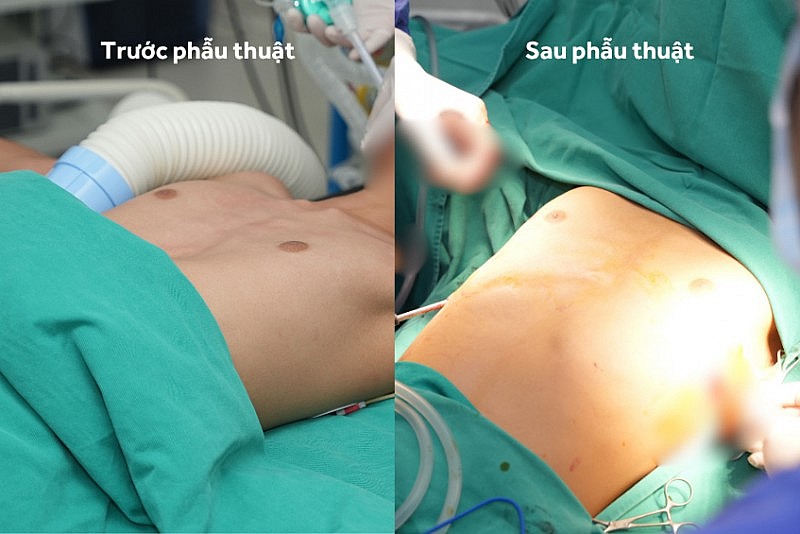Hình ảnh so sánh lồng ngực của bệnh nhân trước và sau phẫu thuật. Hình ảnh so sánh lồng ngực của bệnh nhân trước và sau phẫu thuật.